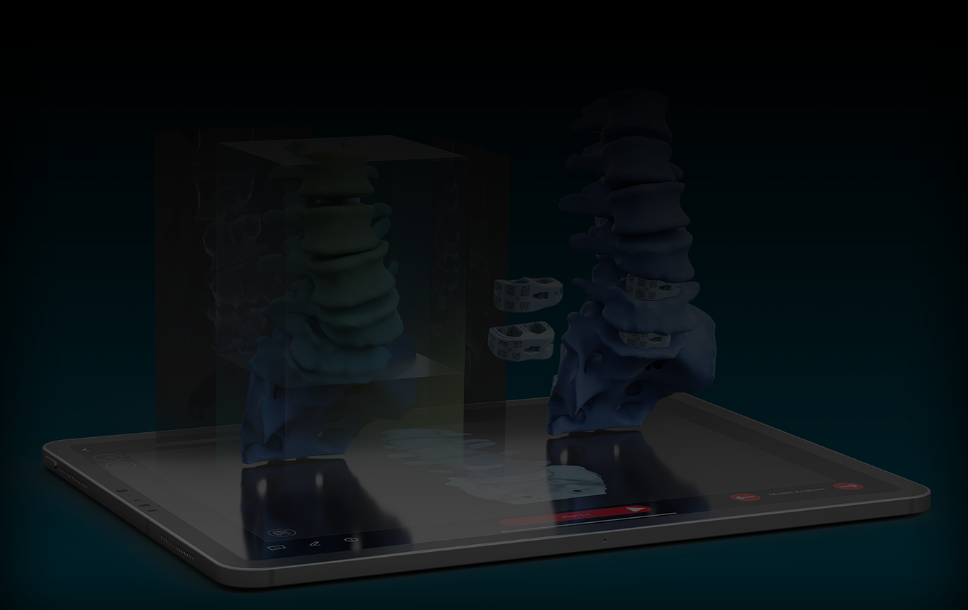 personalized-custom-made-spinal-implants