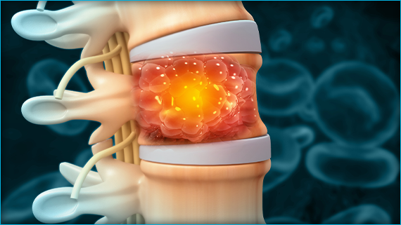 spinal-cord-tumor
