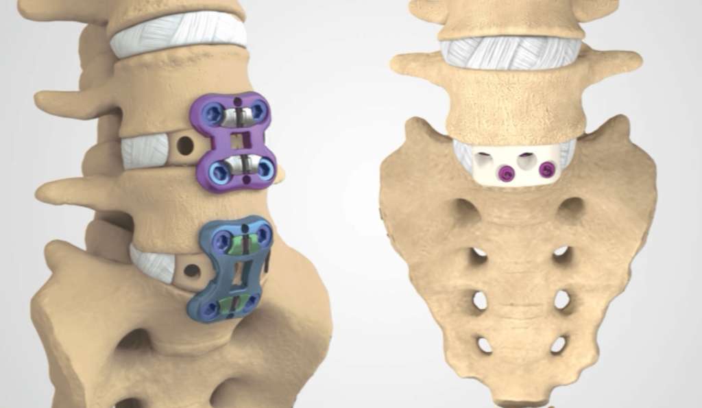 Minimally Invasive Anterior Lumbar Interbody Fusion