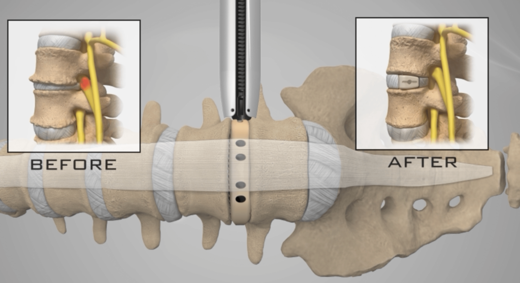 Minimally Invasive Lateral Lumbar Interbody Fusion
