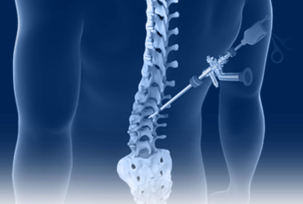 Ultra Minimally Invasive Endoscopic Lumbar Discectomy